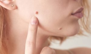Cara Efektif Menghilangkan Kutil pada Wajah