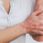 Mengenal Alergi pada Tubuh Beserta Ciri dan Cara Mengatasinya