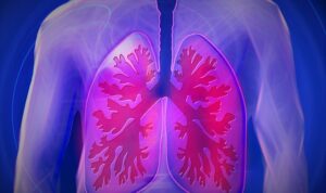 Foto: Ilustrasi penyakit Pneumonia (Sumber: pixabay)