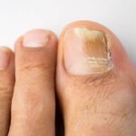 Jamur kuku (Dok. iStock)