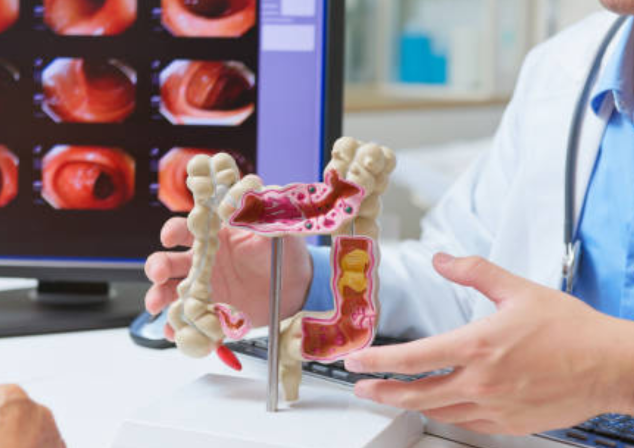 Foto: ilustrasi kanker kolorektal atau usus besar (sumber: istock)