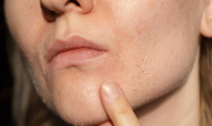 Berikut Cara Merawat Kulit Kering di Tengah Cuaca Panas