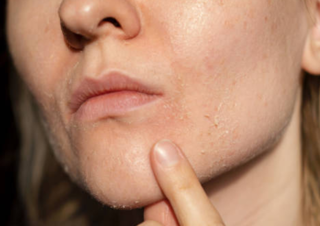 Berikut Cara Merawat Kulit Kering di Tengah Cuaca Panas Berikut Cara Merawat Kulit Kering di Tengah Cuaca Panas