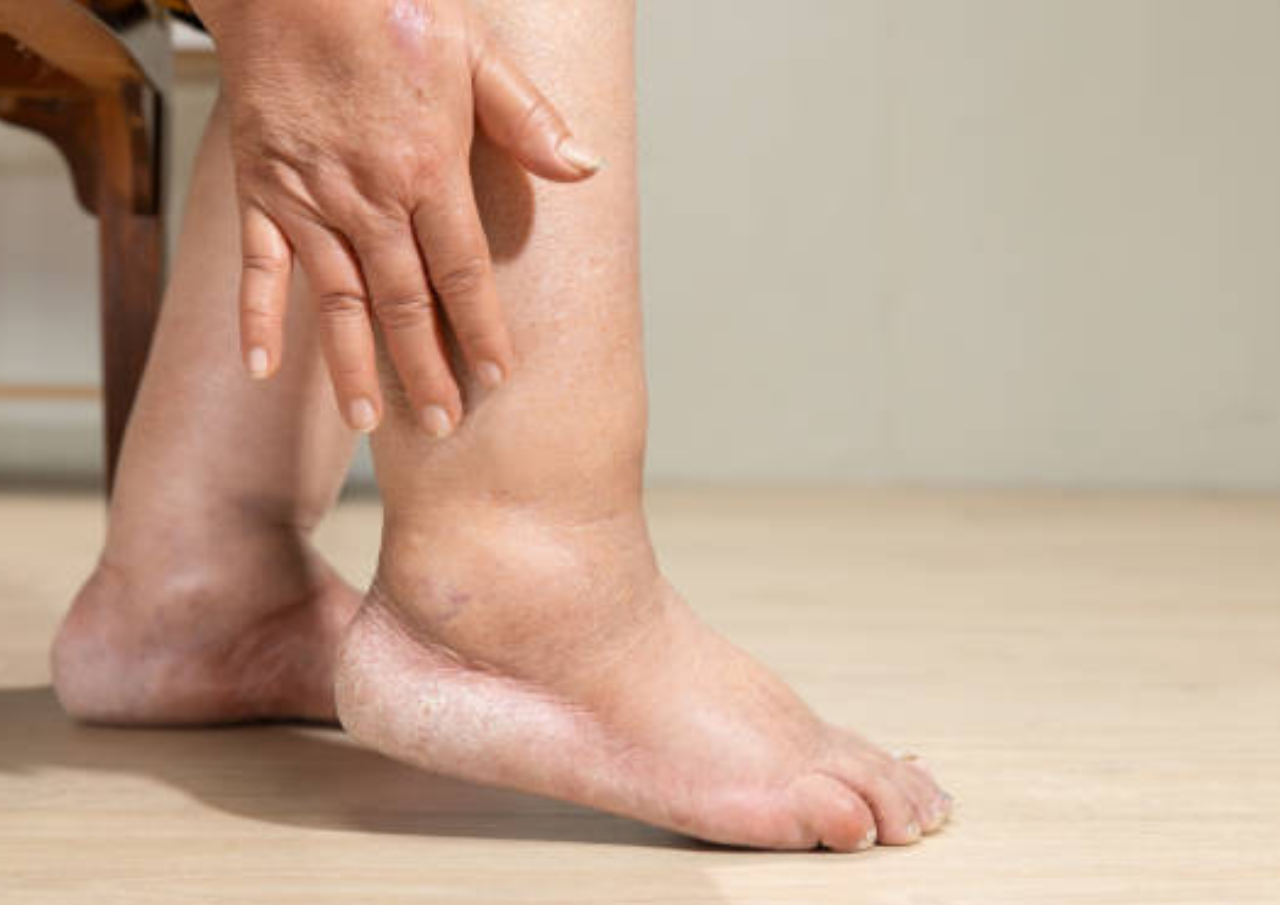 Kendalikan Asam Urat, Berikut Ini Minuman yang Baik Dikonsumsi