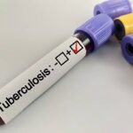 Ilustrasi Tuberkulosis /istock