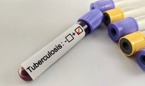 Ilustrasi Tuberkulosis /istock
