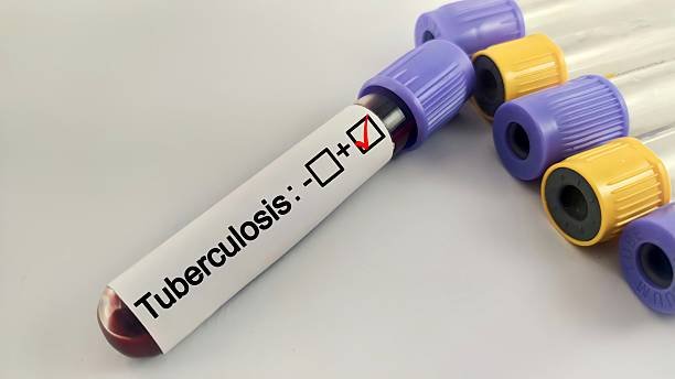 Ilustrasi Tuberkulosis /istock